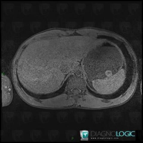 Peutz-Jeghers syndrome, Stomach, MRI