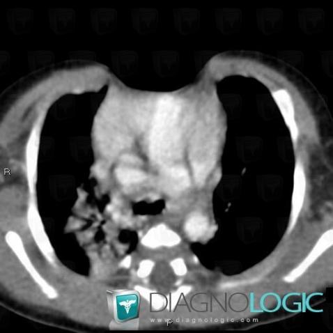 PHACES syndrome, Sternum, CT