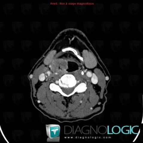 Pharyngeal carcinoma, Pharyngolarynx, CT