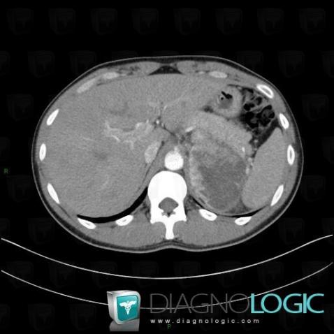 Pheochromocytoma, Adrenal glands, CT