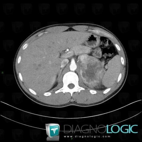 Pheochromocytoma, Adrenal glands, CT