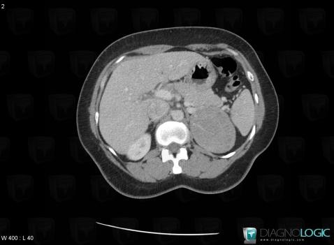 Pheochromocytoma, Adrenal glands, CT