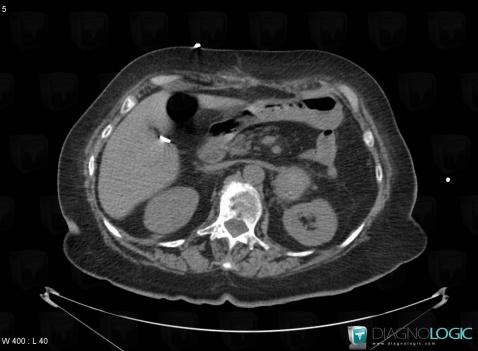 Pheochromocytoma, Adrenal glands, CT