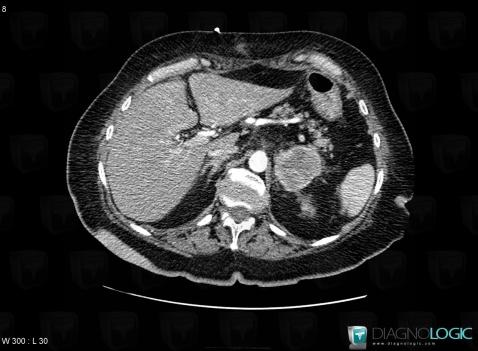 Pheochromocytoma, Adrenal glands, CT