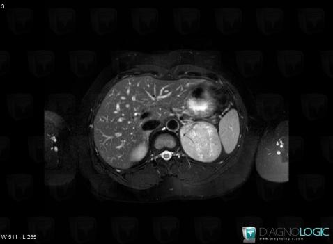 Pheochromocytoma, Adrenal glands, MRI