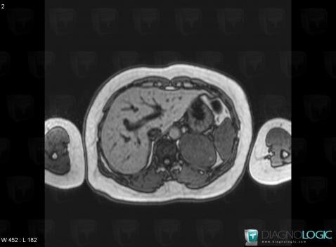 Pheochromocytoma, Adrenal glands, MRI