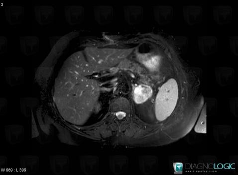 Pheochromocytoma, Adrenal glands, MRI