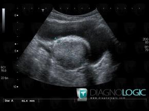 Pheochromocytoma, Pelvis / Perineum, US