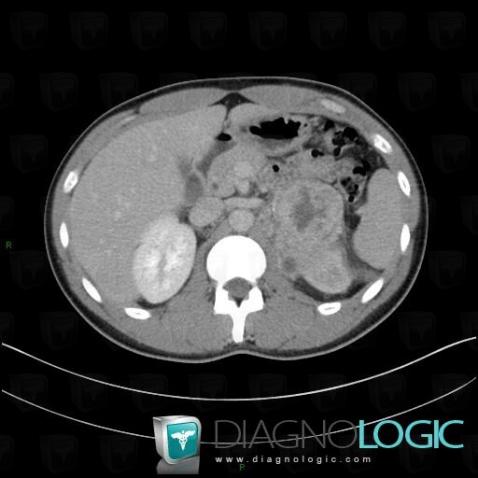 Pheochromocytoma, Retroperitoneum, CT