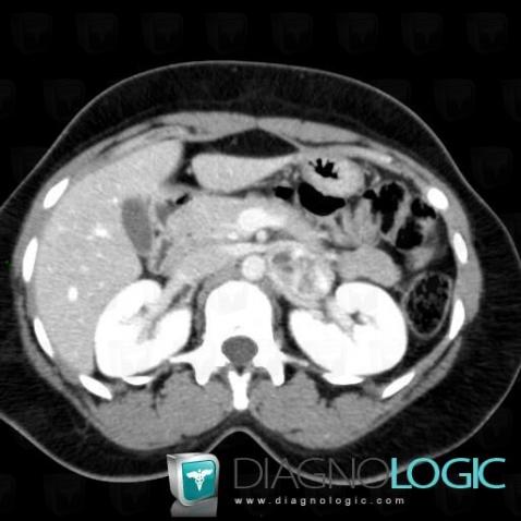 Pheochromocytoma, Retroperitoneum, CT