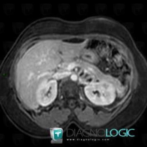 Pheochromocytoma, Retroperitoneum, MRI