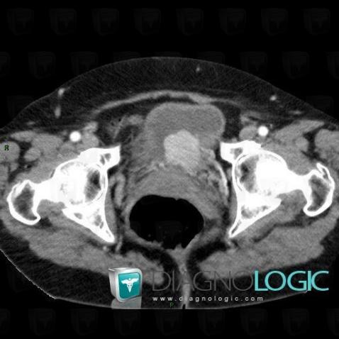 Pheochromocytoma, Urinary bladder, CT