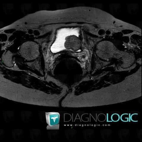 Pheochromocytoma, Urinary bladder, MRI