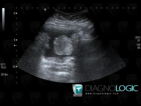 Pheochromocytoma, Urinary bladder, US