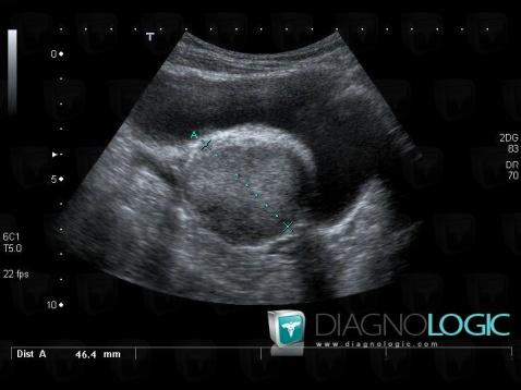 Phéochromocytome, Pelvis / Périnée, Echographie