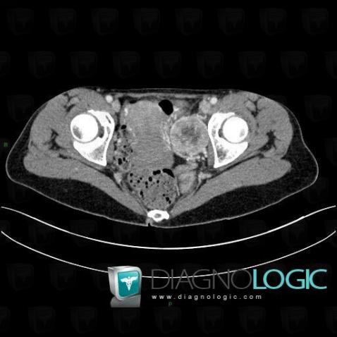 Phéochromocytome, Pelvis / Périnée, Scanner