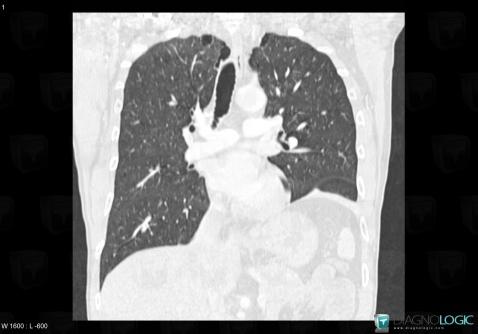 Phrenic nerve paralysis, Diaphragm, CT