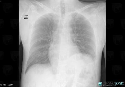 Phrenic nerve paralysis, Diaphragm, X rays