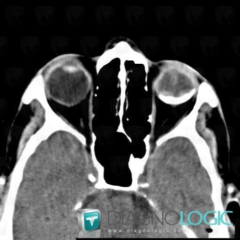 Phthisis bulbi, Eye, CT