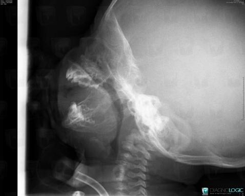 Pierre Robin Syndrome, Mandible, X rays