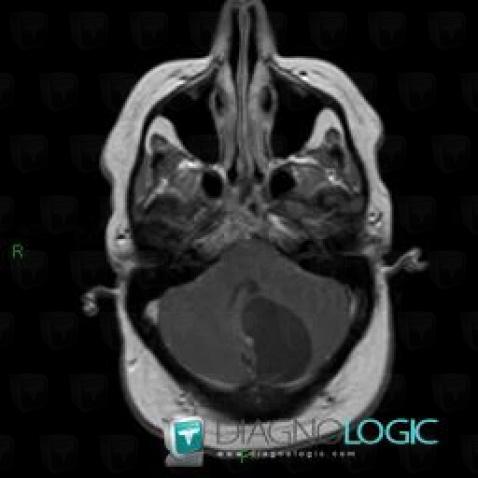 Pilocytic astrocytoma, Cerebellar hemisphere, Posterior fossa, MRI