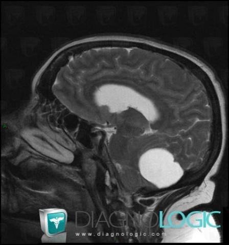 Pilocytic astrocytoma, Posterior fossa, MRI