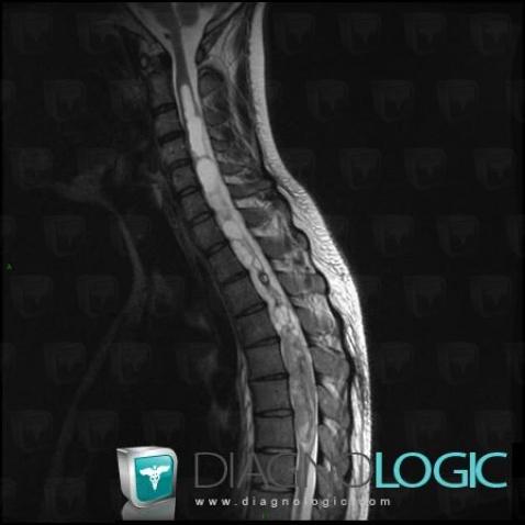 Pilocytic astrocytoma, Spinal canal / Cord, MRI