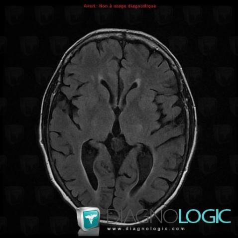 Pineal cyst, Cerebral falx / Midline, MRI