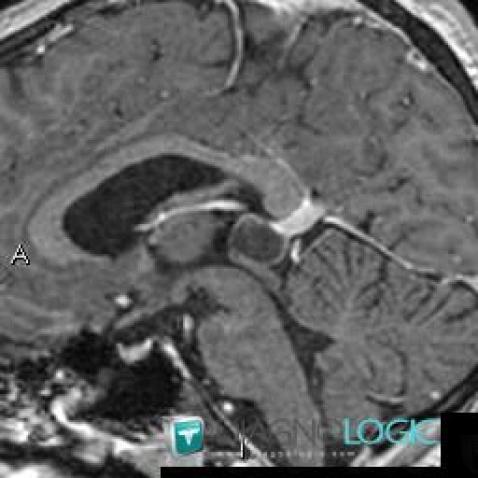 Pineal cyst, Cerebral hemispheres, Cerebral falx / Midline, MRI