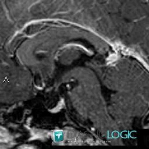 Radiology case : Pineal cyst (MRI) - Diagnologic