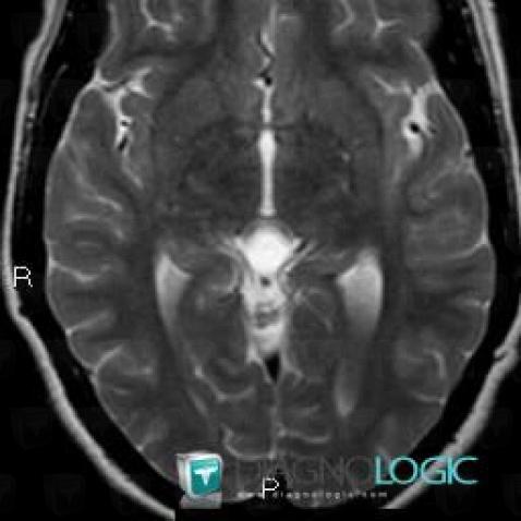 Pineal cyst, Cerebral hemispheres, MRI