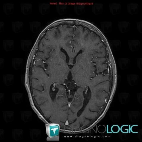 Pineal cyst, Pineal region, MRI