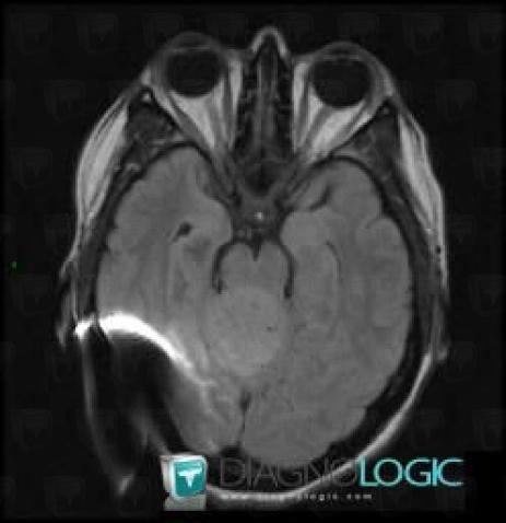 Pineoblastoma, Cerebral hemispheres, MRI