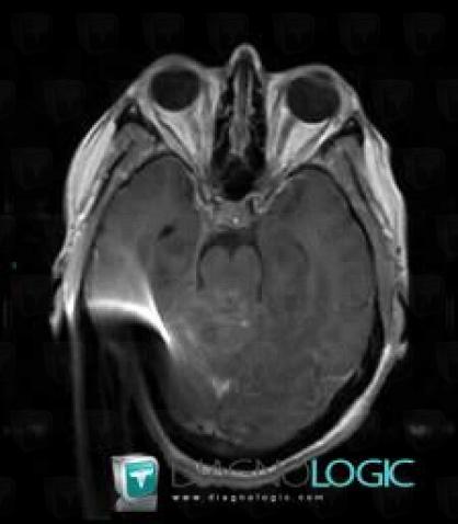 Pineoblastoma, Cerebral hemispheres, MRI