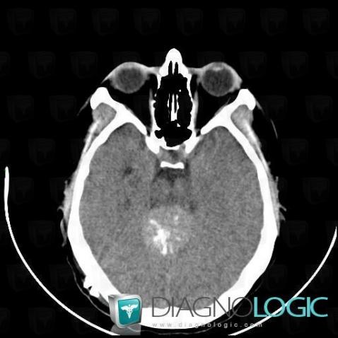 Pineoblastoma, Cerebral hemispheres, Pineal region, CT