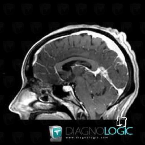 Pineoblastoma, Pineal region, MRI