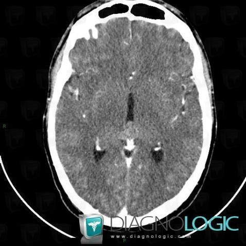 Pineocytoma, Cerebral hemispheres, Cerebral falx / Midline, CT
