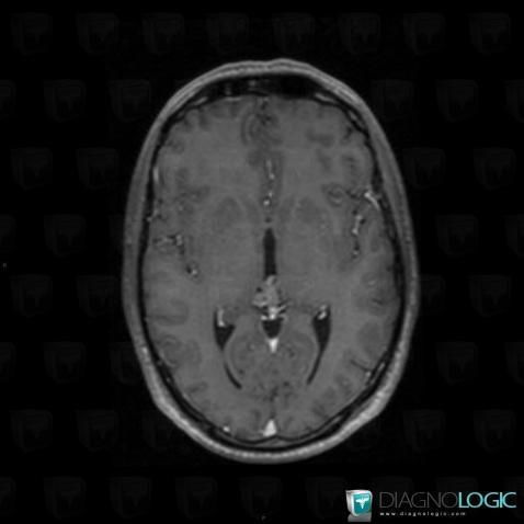 Pineocytoma, Cerebral hemispheres, MRI