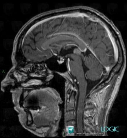 Pineocytoma, Pineal region, MRI