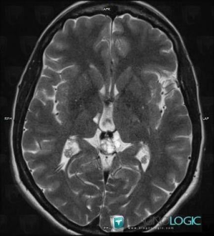 Pineocytoma, Pineal region, MRI