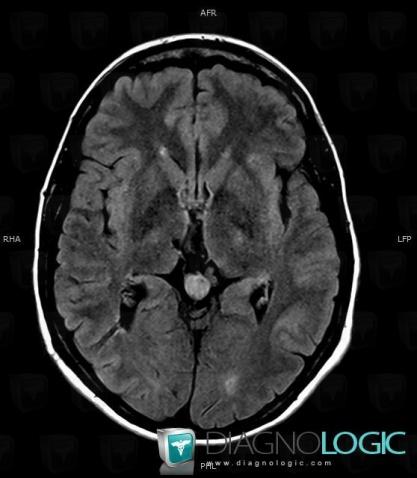 Pineocytoma, Pineal region, MRI