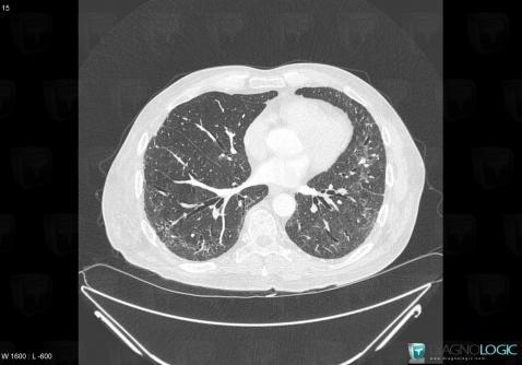 PINS, Parenchyme pulmonaire, Scanner