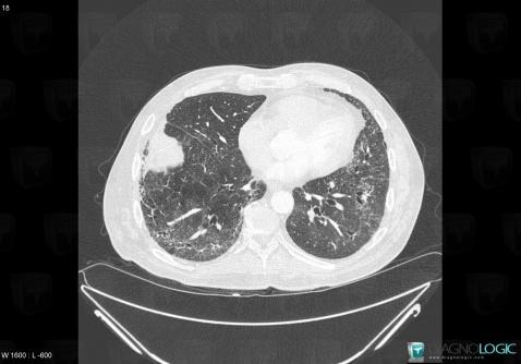 PINS, Parenchyme pulmonaire, Scanner