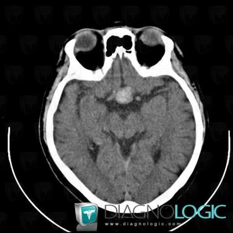 Pituitary apoplexy, Cerebral hemispheres, CT