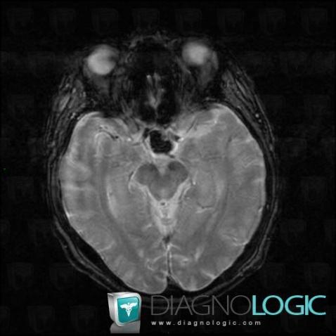 Pituitary apoplexy, Pituitary gland and parasellar region, MRI