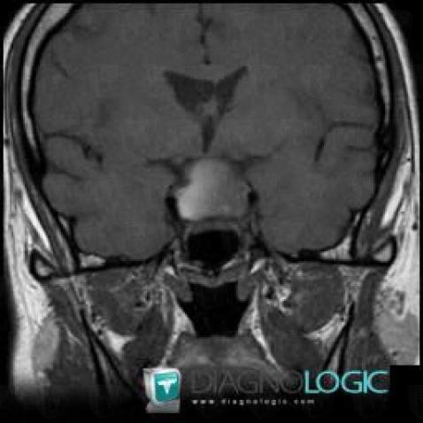 Pituitary apoplexy, Pituitary gland and parasellar region, MRI