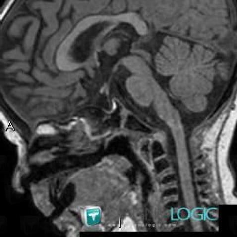 Pituitary atrophy, Pituitary gland and parasellar region, MRI