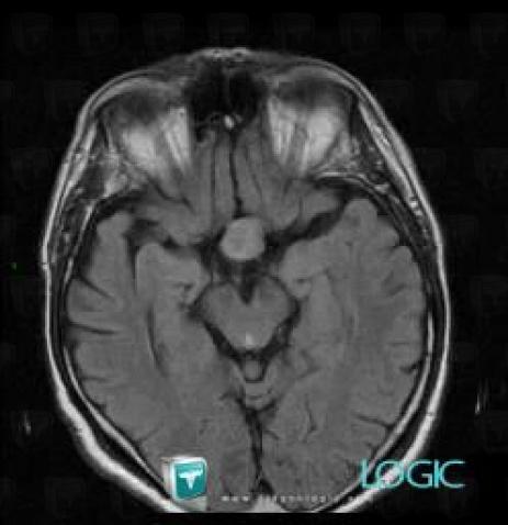 Pituitary macroadenoma, Cerebral hemispheres, MRI