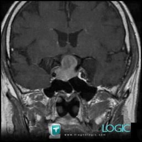 Pituitary macroadenoma, Cerebral hemispheres, MRI