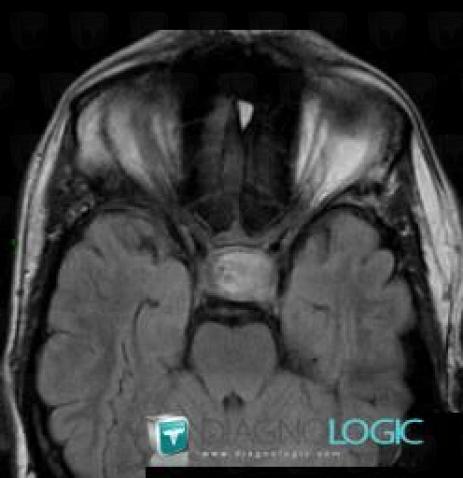 Pituitary macroadenoma, Cerebral hemispheres, MRI